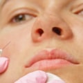 What Can't You Do After Dysport Treatment?